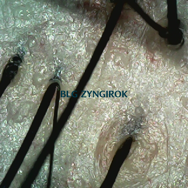 탈모 극복 프로젝트 - 뒷머리 두피 모습이다.