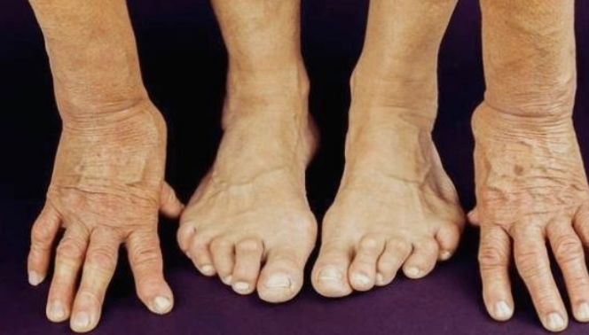 류마티스관절염-환자-사진