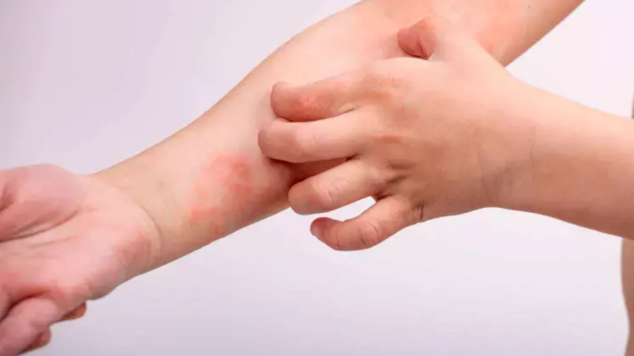 백반증 완벽 가이드