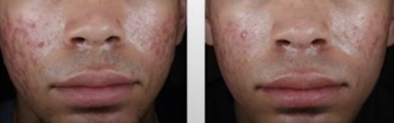 아클리프-크림으로-여드름-없애는-방법