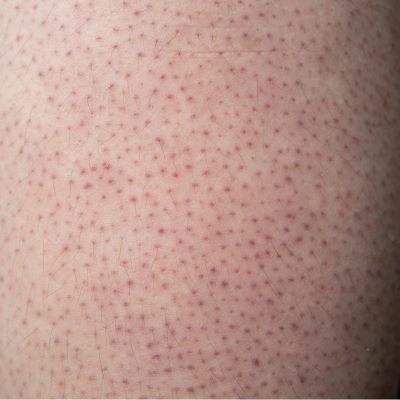 모공각화증의 원인, 증상, 대처 방법