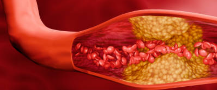 고지혈증 증상&amp;#44; 고지혈증에 좋은 음식&amp;#44; 고지혈증 수치 총정리 (2024ver)
