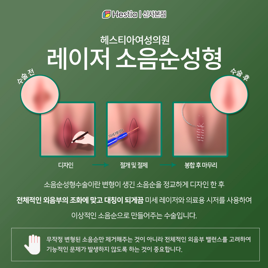 헤스티아 레이저 소음순수술