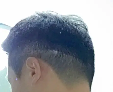 짧은 머리 했을때, 모발이식 절개흉터