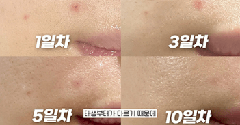 상처 흉터 재생 연고