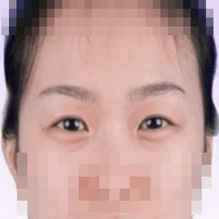 상안검 수술 전 여성의 모습