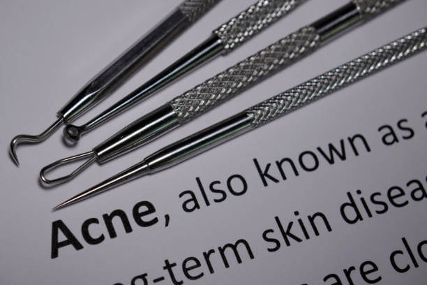 소극성 속모증은 블랙헤드와는 다른 증상이 있습니다. 간혹 콧등이나 콧볼에 작고 검은 점들이 조밀하게 형성되어 있는 것을 보고 보통 블랙헤드이지만&amp;#44; 모공 밖으로 나오는 검은 털인 속극성 속모증이 보이는 경우도 있습니다. 어떤 증상과 원인 치료방법이 있는지 참고하시기 바랍니다. 