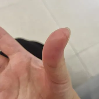 수족구 어른 전염에 대한 원인과 예방법 정리_22