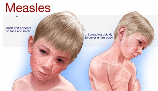 홍역예방접종 성인 홍역 예방접종