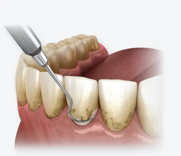 스케일링-치석-치주질환