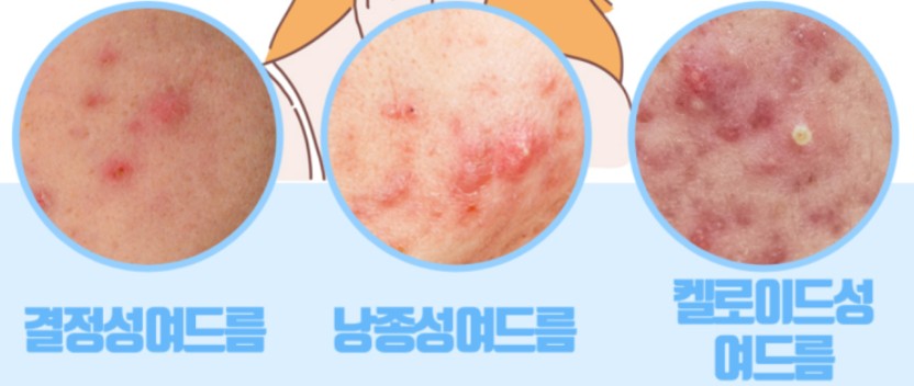 여드름 종류