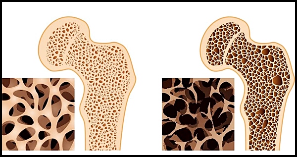골다공증에 좋은 음식 BEST 8