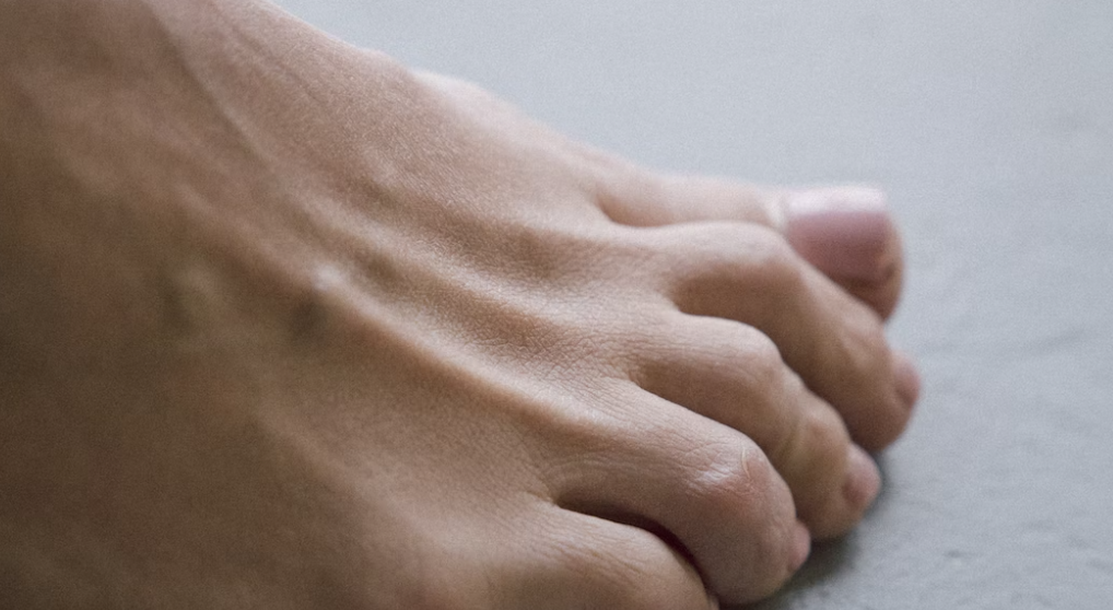 엄지발가락의 통증이나 휨이 있다면 무지외반증 의심해봐요