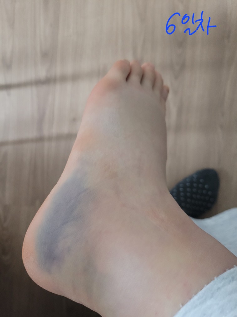 발목-접질렀을-때