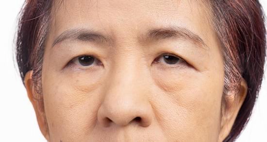 안검하수