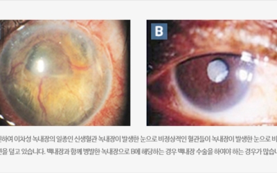 녹내장 이미지