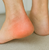 족저근막염 증상