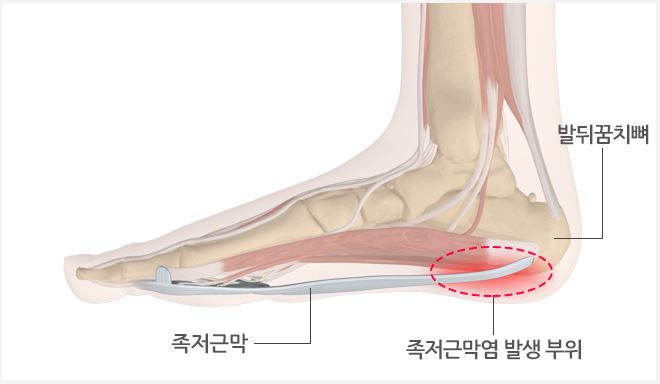 족저근막염 관련 사진