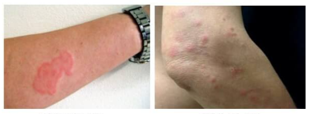 빈대에 물린 자국