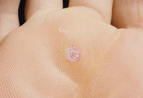 사마귀 제거방법 4