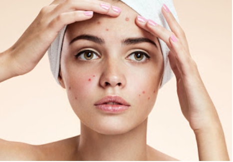 부위별 여드름 원인