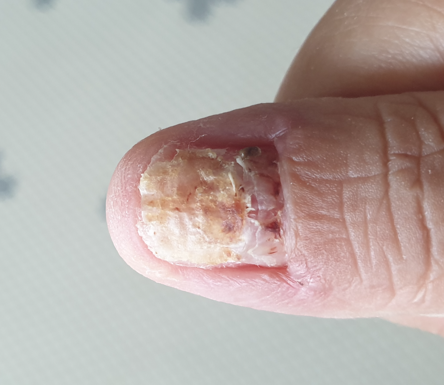 손톱 나오는 과정