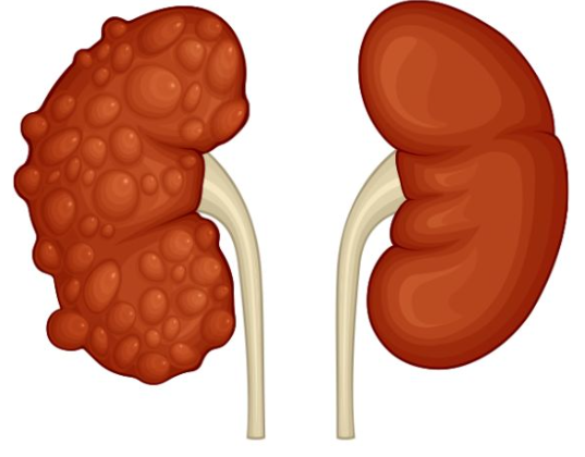 방치하면 생명에 위험으로 다가오는 만성신부전 특징과 예방법