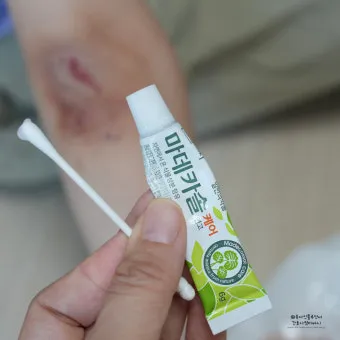후시딘과 마데카솔 차이와 상처별 추천 사용법까지 정리한 내용_7