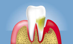 잇몸이 붓고 아플 때