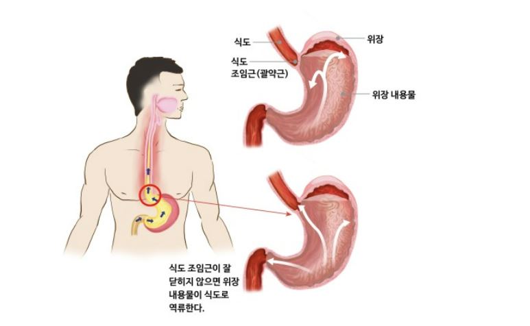 역류성 식도염의 증상 부위와 위의 역류현상에 대한 인체설명 그림