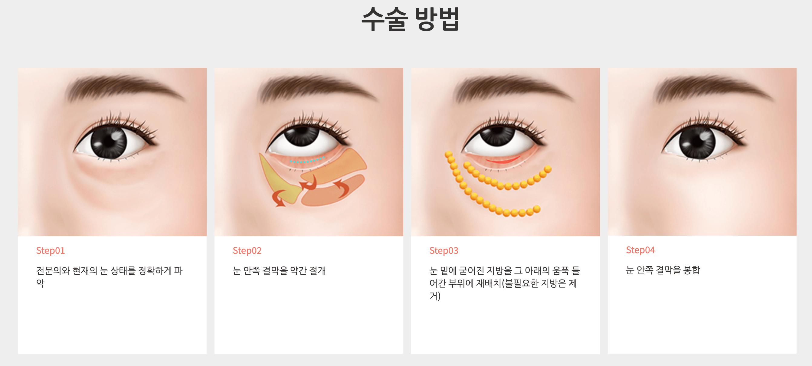 지방재배치 수술 방법
