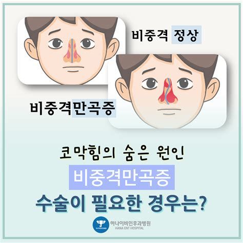 비중격만곡증수술