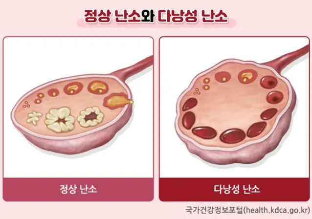 다낭성-난소-증후군이란