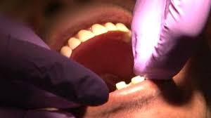 혓바늘 없애는 방법