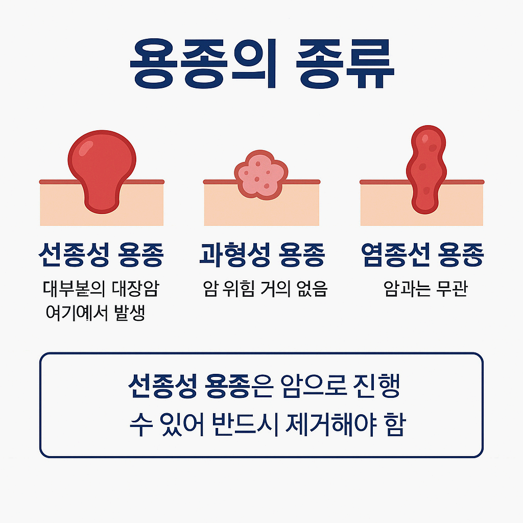 대장용종종류
