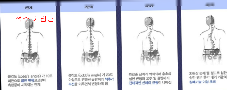 척추 기립근1
