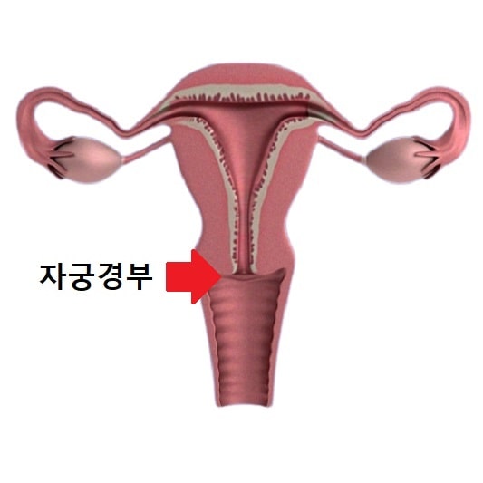 자궁경부암 주사