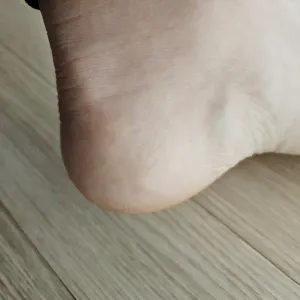 발뒤꿈치 갈라짐