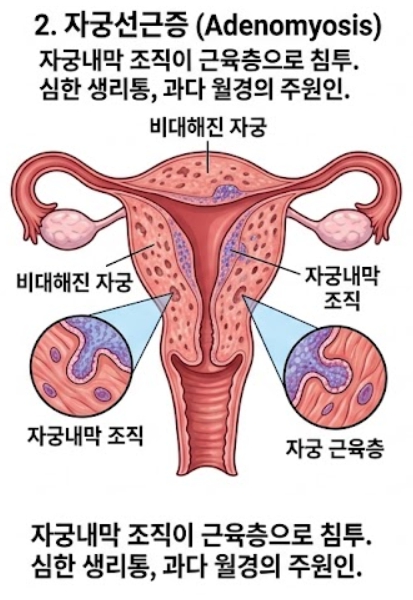 자궁선근증