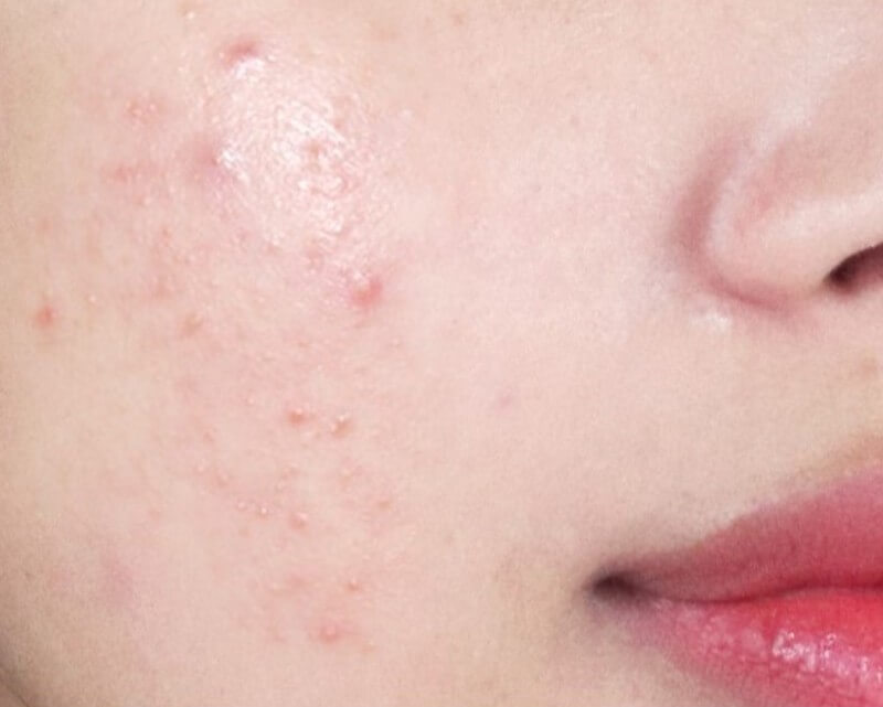 이마에 난 여드름