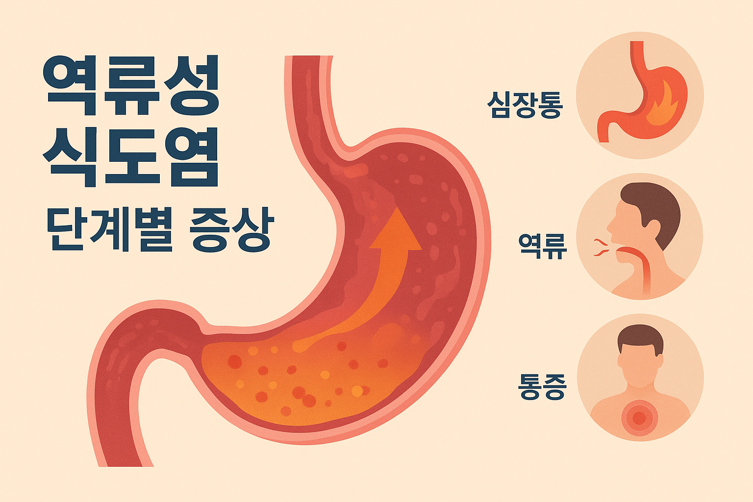 역류성 식도염 단계별 증상