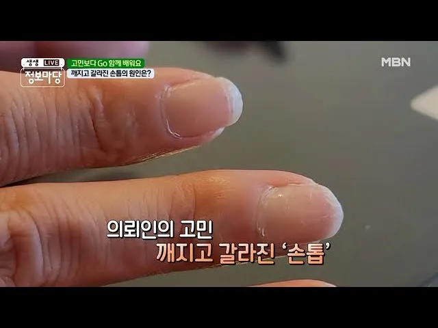 손톱이 갈라지는 이유 원인 증상 대처법_1