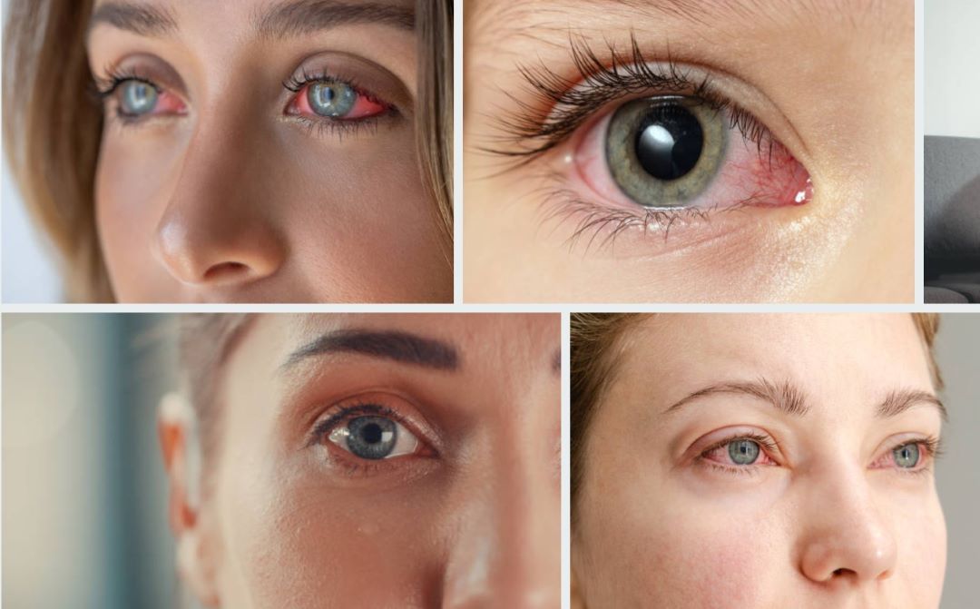 눈충혈 고치는 방법 원인 예방 치료