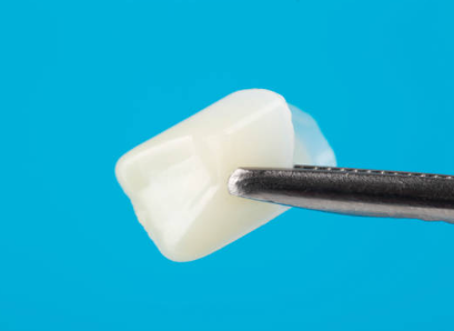 임플란트 뼈이식