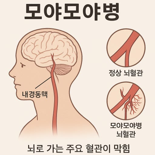 모야모야병의 증상과 원인