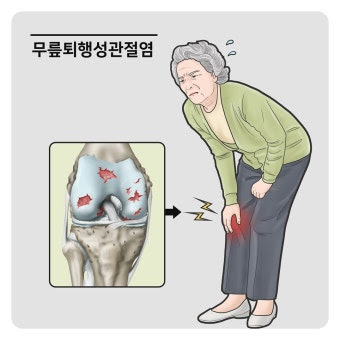 무릎 연골 손상3