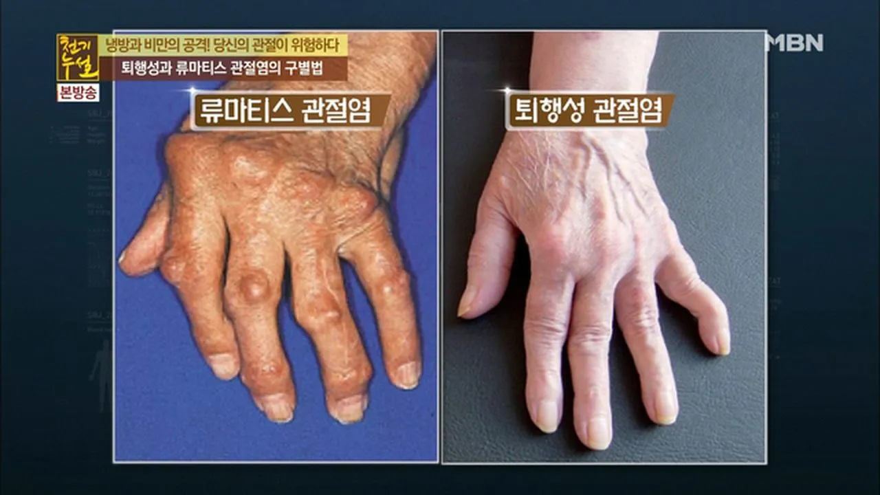 손가락 관절염 증상