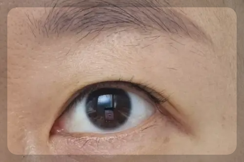 키싱점 제거 후