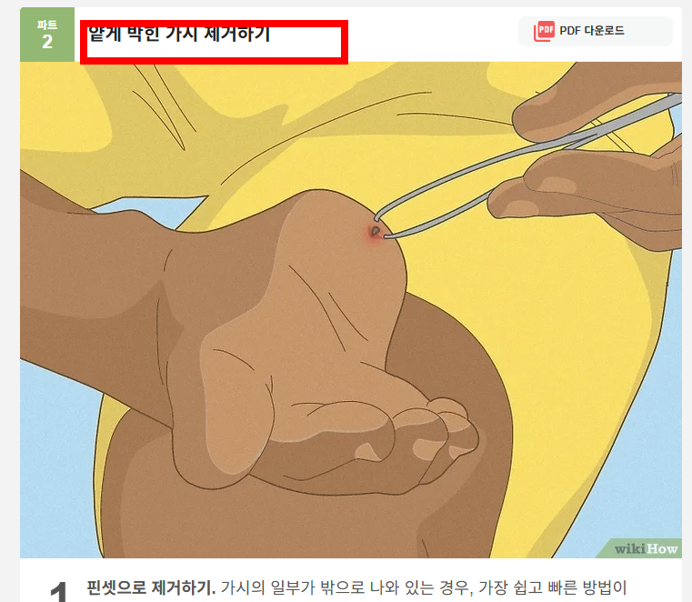 손가락 가시 빼는법 소개