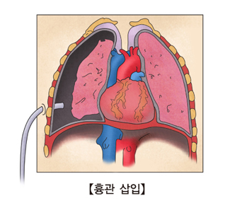 폐기흉 증상 뜻 원인 수술 비용 치료 호흡 곤란 예방법 총정리 2